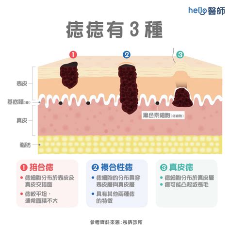 長痣的位置|痣變大、痣多或長毛會變皮膚癌？認識痣的形成與原因